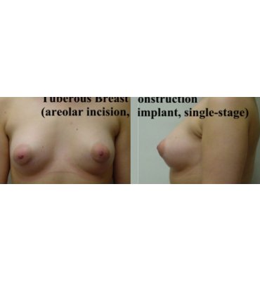 Tuberous Breast Deformity After